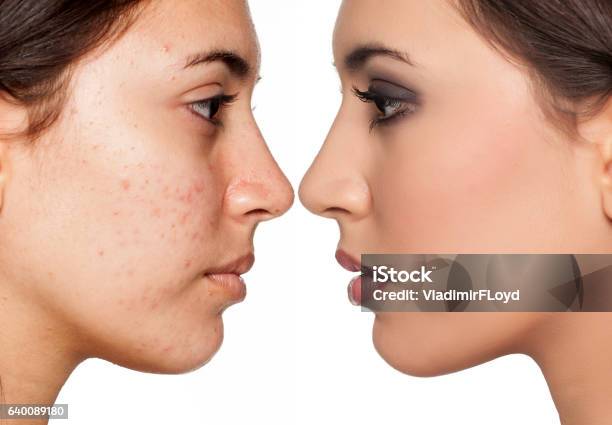 Problematic Skin Without And With Makeup Stockfoto en meer beelden van Acne - Acne, Menselijk gezicht, Make-up