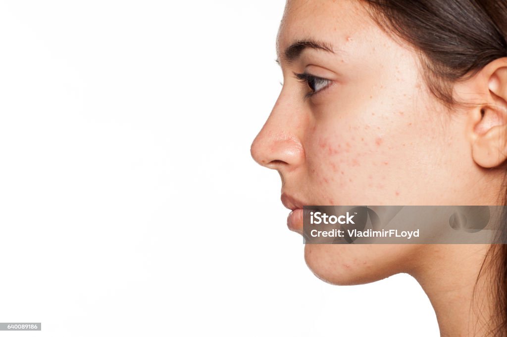 profile of young girl with acne on white background Acne Stock Photo