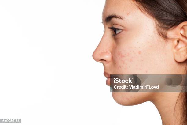 Profile Of Young Girl With Acne On White Background Stock Photo - Download Image Now