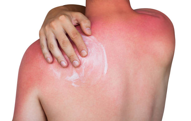 man with reddened itchy skin after sunburn A man with reddened itchy skin after sunburn, smears cream on the skin. Skin care and protection from the sun's ultraviolet rays. melanin photos stock pictures, royalty-free photos & images