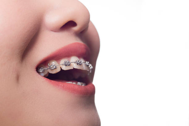istock closeup of the teeth and  braces 641043820