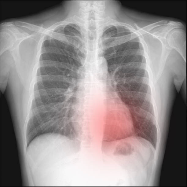 pneumothorax dans une radiographie pulmonaire qui veulent intercostral drainage. - joueur de champ gauche photos et images de collection