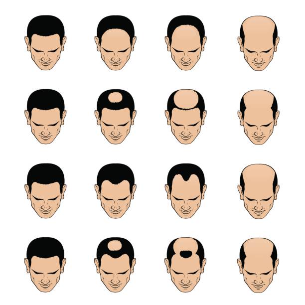 Hairl loss patterns and stages for men Information chart showing types and stages of hair loss for men. Bolding head from full hair cover to a final stage of baldness. completely bald stock illustrations