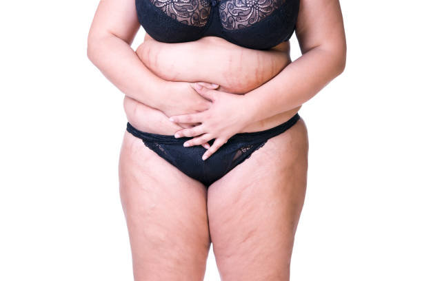 istock Fat female belly after pregnancy, stretch marks closeup 641581056