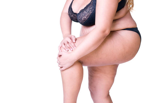 과 체중 여성의 몸 무릎에 통증이와 뚱뚱한 여자 무릎에 대한 스톡 사진 및 기타 이미지 - 무릎, 아픔, 다리-신체 부분 - iStock 과 체중 여성의 몸 무릎에 통증이와 뚱뚱한 여자 무릎에 대한 스톡 사진 및 기타 이미지 - 무릎, 아픔, 다리-신체 부분 - Istock