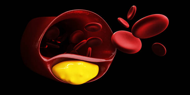 ilustración 3d de las células sanguíneas con la acumulación de placa de símbolo de colesterol de la enfermedad vascular. negro aislado - rusk county fotografías e imágenes de stock