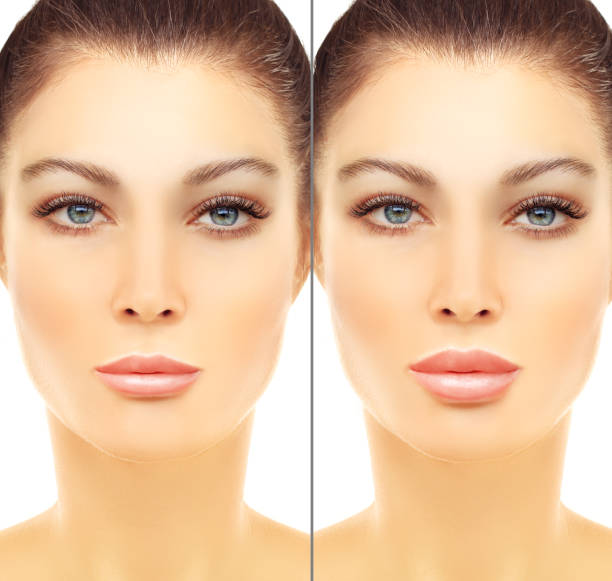 istock Beauty injections.Lip augmentation 641681272