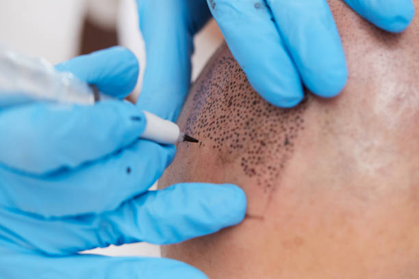 professional tattooist making permanent make up tricopigmentation MARTY fototesseraprofessional tattooist making permanent make up tricopigmentationprofessional tattooist making permanent make up tricopigmentation skinhead haircut stock pictures, royalty-free photos & images