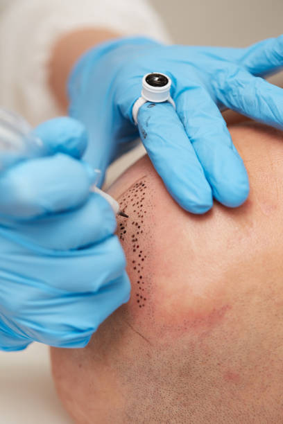 professional tattooist making permanent make up tricopigmentation professional tattooist making permanent make up tricopigmentationprofessional tattooist making permanent make up tricopigmentation skinhead haircut stock pictures, royalty-free photos & images