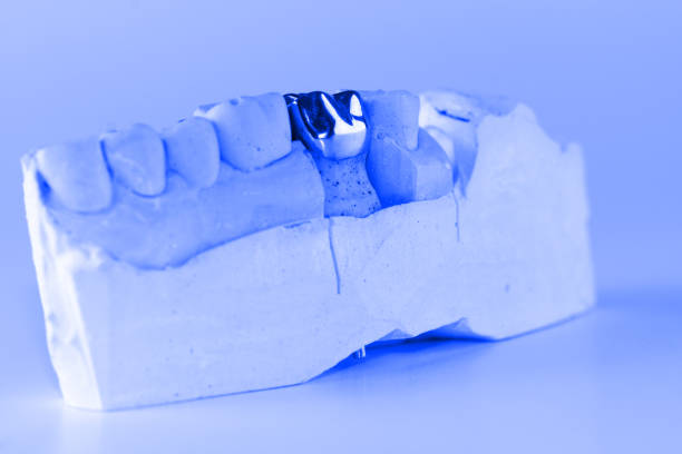istock cast metal dental crown 642302080