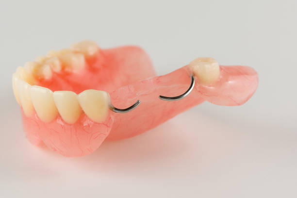 istock acrylic denture with metal clasps 642476182