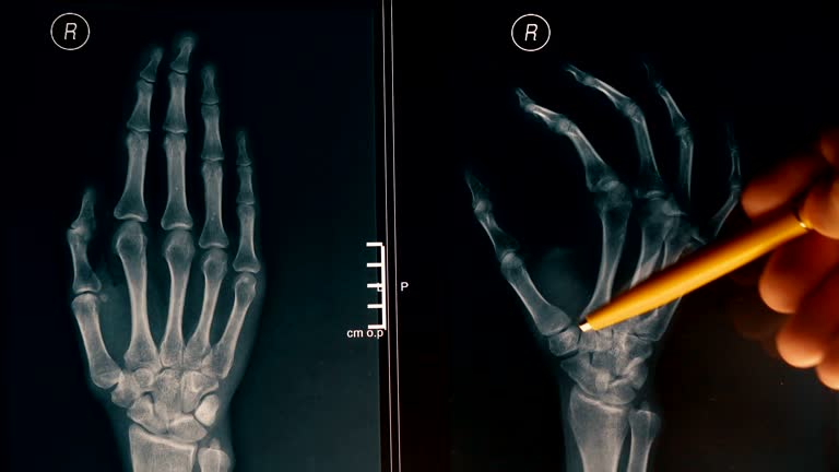 Doctor explains xray image of a hand to a patient. FullHD close-up shot