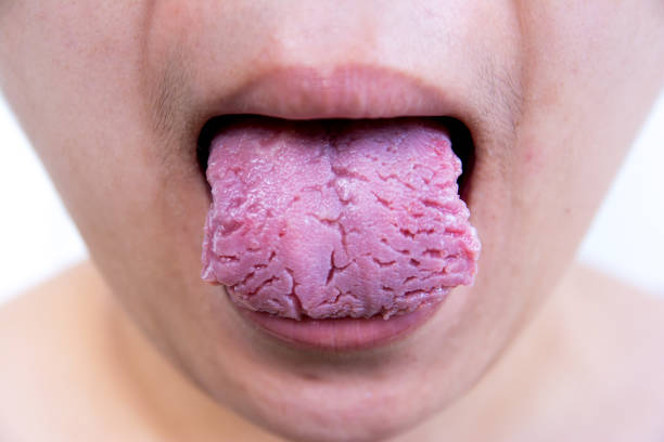 infección bacteriana enfermedad lengua, la lengua es el tordo. lengua de la herida. lengua fisurada - thrush fotografías e imágenes de stock