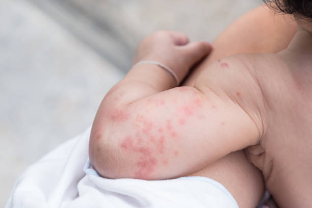 Baby skin texture suffering severe urticaria, nettle rash. stock photo