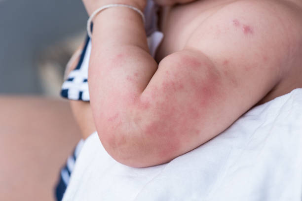 Baby skin texture suffering severe urticaria, nettle rash. stock photo