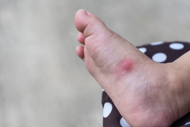 istock Allergic rash skin of baby's right foot. 644940788