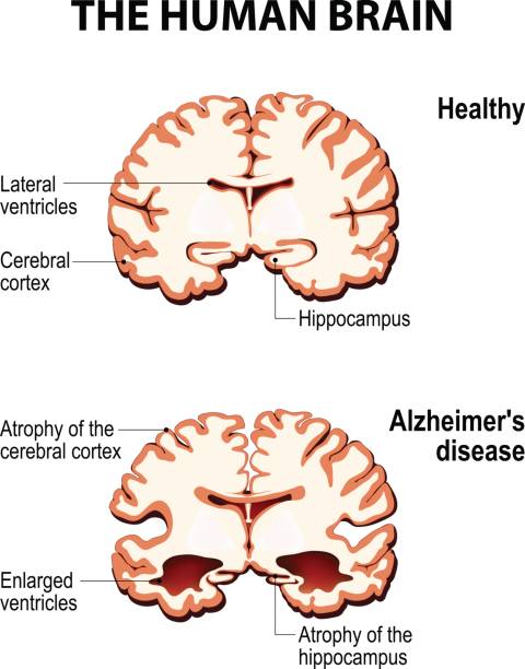 bildbanksillustrationer, clip art samt tecknat material och ikoner med tvärsnitt av den mänskliga hjärnan med alzheimers sjukdom - amyloid