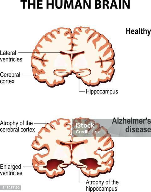 Crosssection Of The Human Brain With Alzheimers Disease Stock Illustration - Download Image Now