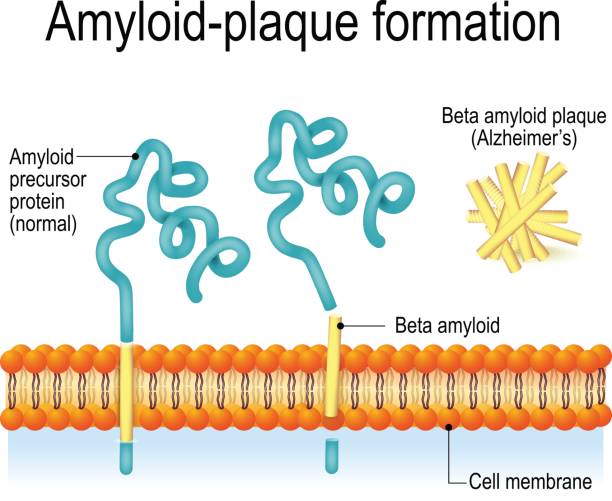 Amyloid-plaque formation. Alzheimer's disease Cell membrane with Amyloid precursor protein (APP) and beta amyloid. Amyloid-plaque formation. Alzheimer's disease integral stock illustrations