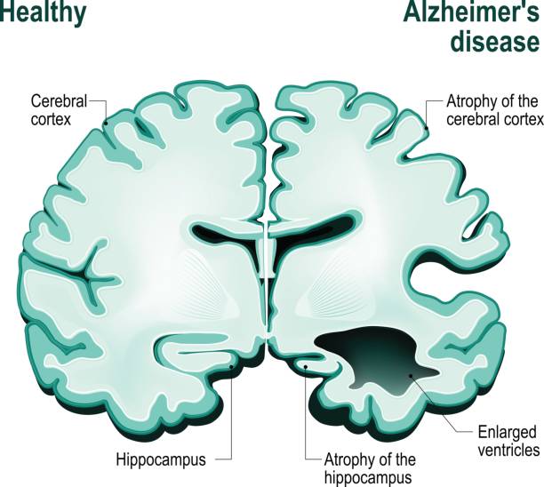 Cross section of the human brain. Healthy brain compared to Alzheimer's disease Cross section of the human brain. Healthy brain compared to Alzheimer's disease (dementia, senility) cortex stock illustrations