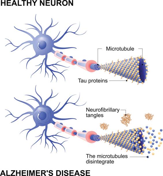 healthy cell and neurons with Alzheimer's disease. Tau hypothesis Alzheimer's disease is the change in tau protein that results in the breakdown of microtubules in brain cells. Mechanism of disease. Diagram shows two neurons: healthy cell and neuron with Alzheimer's disease. Tau hypothesis. Neurofibrillary tangles nervous tissue stock illustrations