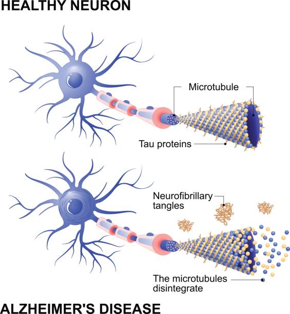 healthy cell and neurons with Alzheimer's disease. Tau hypothesis Alzheimer's disease is the change in tau protein that results in the breakdown of microtubules in brain cells. Mechanism of disease. Diagram shows two neurons: healthy cell and neuron with Alzheimer's disease. Tau hypothesis. Neurofibrillary tangles neuron axon stock illustrations