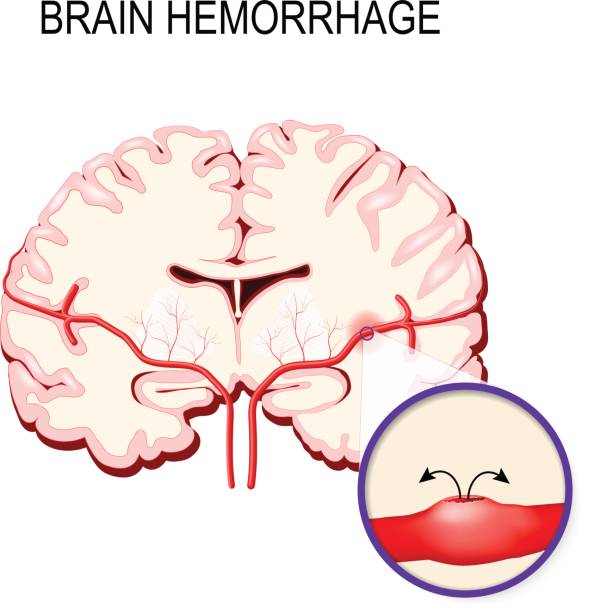cerebral hemorrhage Cerebral hemorrhage. Stroke and Bleeding inside the human brain. cerebrum stock illustrations