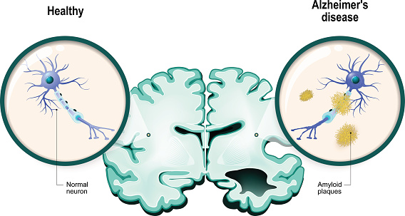 human brain, in two halves: healthy and Alzheimer's disease. Healthy neuron and neuron with amyloid plaques. in comparison