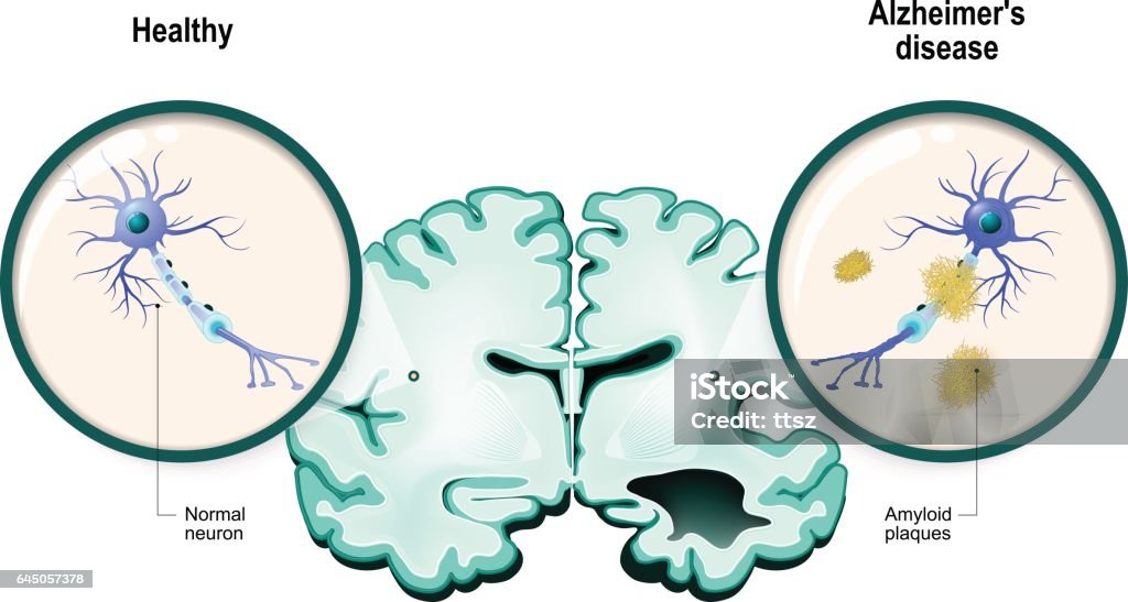Alzheimer's disease. Neurons and brain human brain, in two halves: healthy and Alzheimer's disease. Healthy neuron and neuron with amyloid plaques. in comparison Alzheimer's Disease stock vector