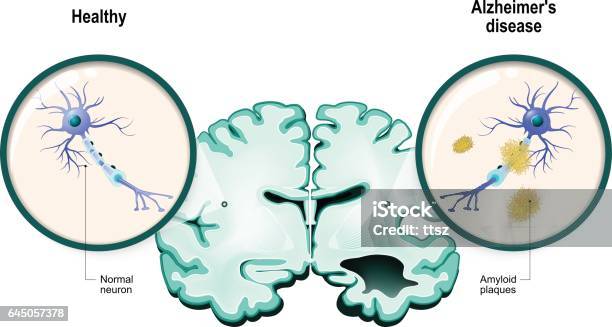 Alzheimers Disease Neurons And Brain Stock Illustration - Download Image Now - Alzheimer's Disease, Amyloid, Nerve Cell