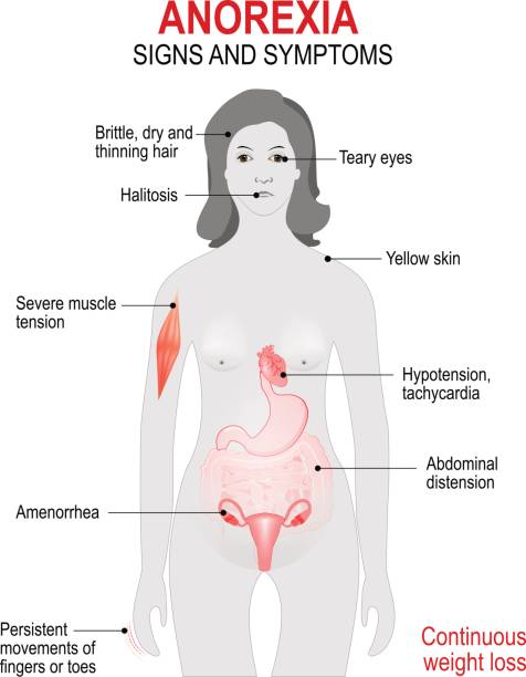 анорексии. признаки и симптомы. - bulimia stock illustrations