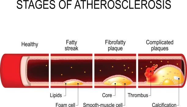 стадии атеросклероза - human artery cholesterol atherosclerosis human heart stock illustrations