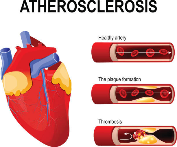 Atherosclerosis stages Atherosclerosis stages: Healthy artery, the plaque formation and thrombosis. Anatomy of a heart attack. Diagram of a myocardial infarction. Atherosclerotic plaque in a coronary artery. Arteries are narrowed when fatty deposits called plaques build up inside clogged artery stock illustrations