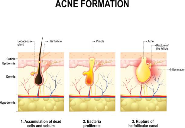 acne formation. human skin. Three stages of the acne formation in the human skin. The sebum in the clogged pore promotes the growth of a bacteria Propionibacterium Acnes. This leads to the redness and inflammation, that associated with pimples. For clinics and Schools epidermal cell stock illustrations