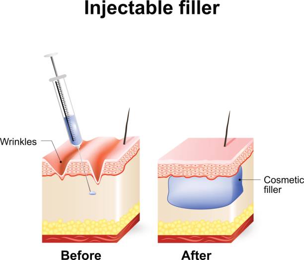 injectable cosmetic filler.  How it works injectable cosmetic filler. How it works. Procedure. Before and after injection. botox before and after stock illustrations