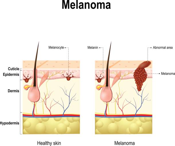 меланома или рак кожи. - melanocyte stock illustrations