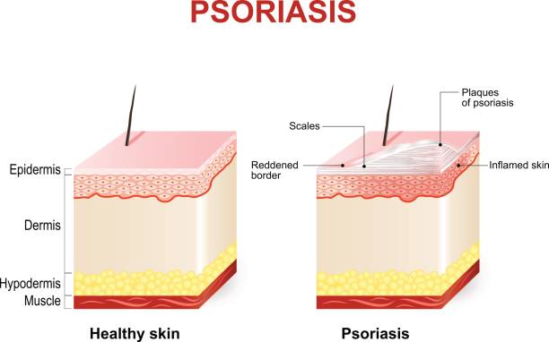 Psoriasis Symptoms of psoriasis. Normal skin and psoriasis. plaque psoriasis skin inflammation stock illustrations