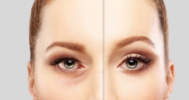 istock Lower Blepharoplasty.Upper blepharoplasty 645193074