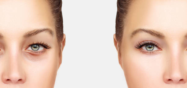 istock Lower Blepharoplasty.Upper blepharoplasty 645193088