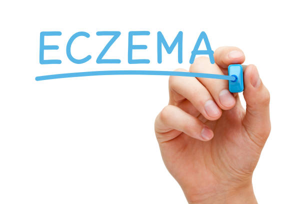 istock Eczema Handwritten With Blue Marker 645378188