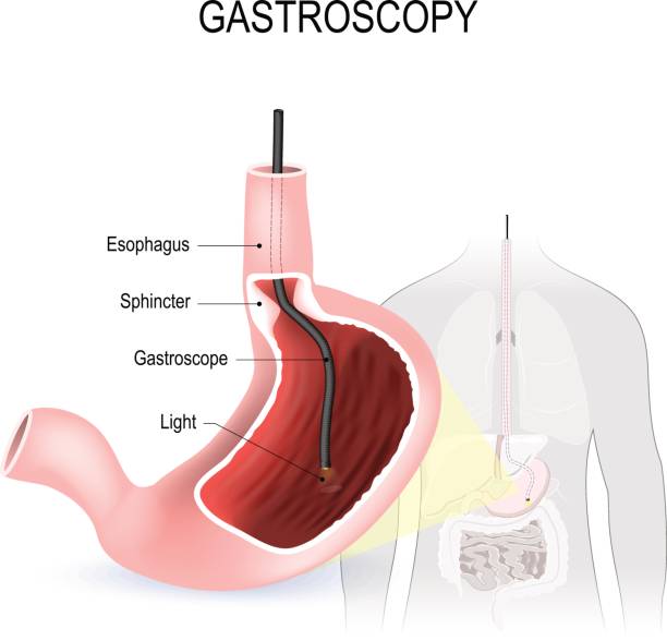 illustrazioni stock, clip art, cartoni animati e icone di tendenza di gastroscopia, esofagoscopia e duodenoscopia - piloro