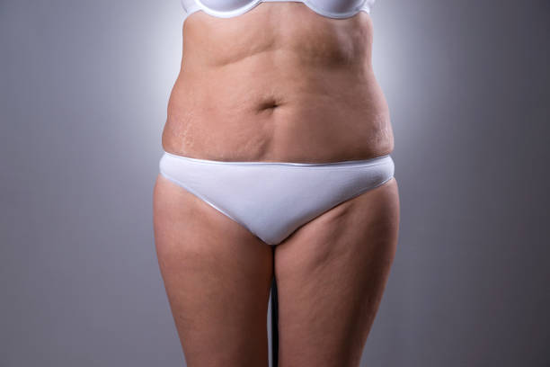 flabby woman's belly with stretch marks - overweight tummy tuck abdomen body imagens e fotografias de stock