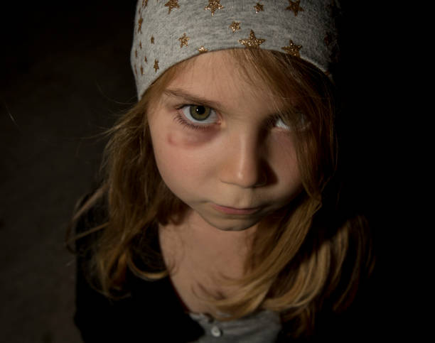 istock Little Girl with a Bruised Eye 645598096