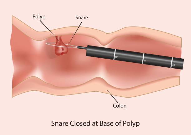 illustrations, cliparts, dessins animés et icônes de la coloscopie et la polypectomie - infection du tube intestinal