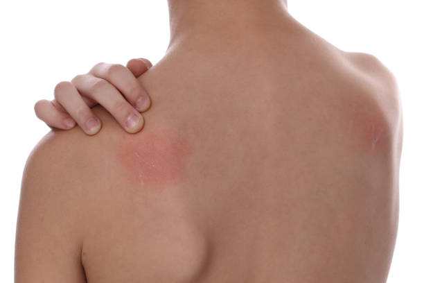 istock Child Scratching an itch isolated on white background . Sensitive Skin, Allergic Reaction, Irritation 645758412