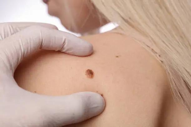 Photo of Doctor dermatologist examines birthmark of patient close up islolated on white background. Checking benign moles. Laser Skin tags removal