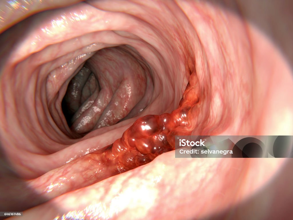 Colorectal cancer Untreated colorectal polyps can develop into colorectal cancer Colorectal Cancer Stock Photo