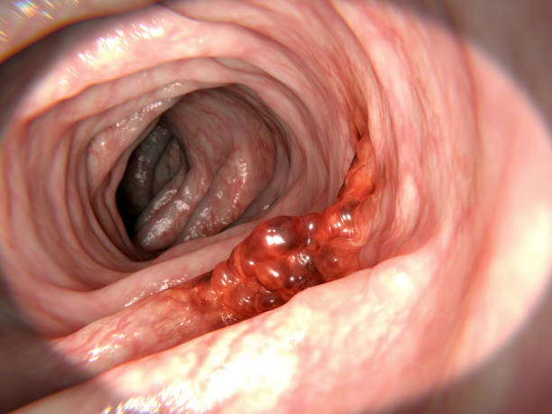 Colorectal cancer Untreated colorectal polyps can develop into colorectal cancer colorectal cancer photos stock pictures, royalty-free photos & images
