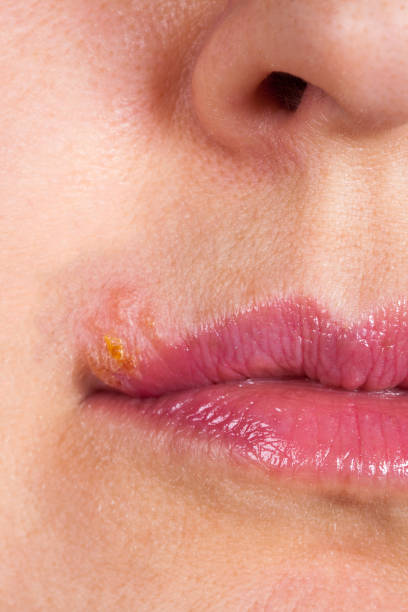 istock Herpes on the lip close up macro 646183830