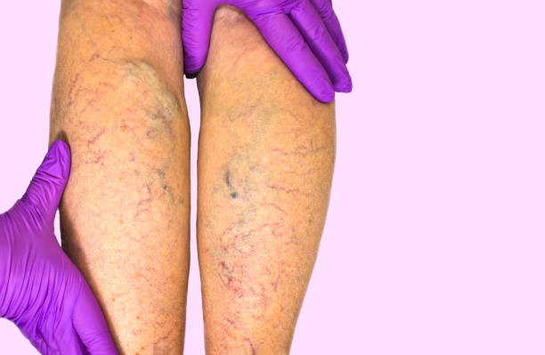 Lower limb vascular examination because suspect of venous insufficiency Lower limb vascular examination because suspect of venous insufficiency. The female legs on pink background spider veins stock pictures, royalty-free photos & images